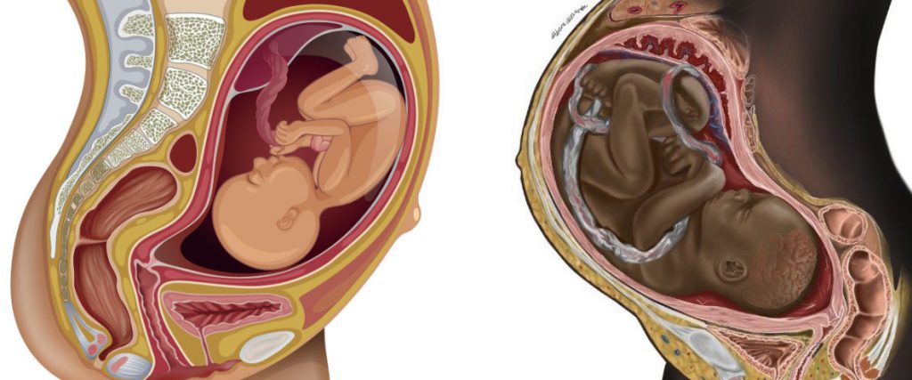 Eine medizinische, schematische Darstellung eines Fötus im Bauch der Mutter. Beide haben eine dunkle Hautfarbe.